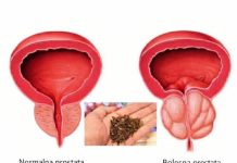 Spas za muškarce: Riješite probleme prostate na prirodan način!