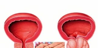 Spas za muškarce: Riješite probleme prostate na prirodan način!