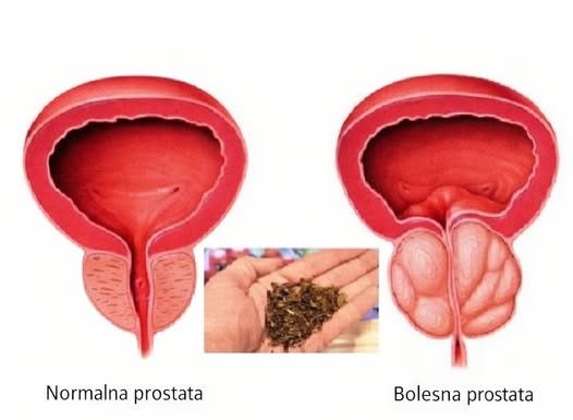 Spas za muškarce: Riješite probleme prostate na prirodan način!