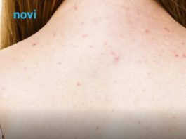 Kako se nositi s prištićima na leđima? 6 grešaka koje pogoršavaju stanje kože i pojačavaju problem