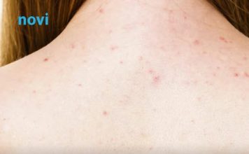 Kako se nositi s prištićima na leđima? 6 grešaka koje pogoršavaju stanje kože i pojačavaju problem