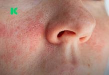 Ako imate ekcem, ovo morate znati prije nego nanesete šminku!