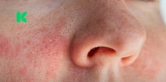 Ako imate ekcem, ovo morate znati prije nego nanesete šminku!