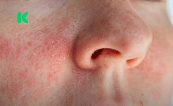 Ako imate ekcem, ovo morate znati prije nego nanesete šminku!