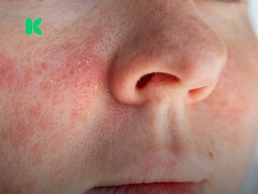 Ako imate ekcem, ovo morate znati prije nego nanesete šminku!