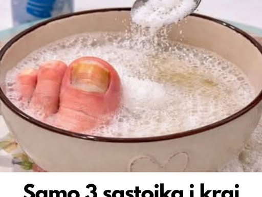 Samo 3 sastojka za žute i zadebljale nokte! GLJIVICE NA NOKTIMA KAO RUKOM ODNESENE…