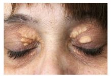 Ukoliko imate MASNO TKIVO ispod oka ovo MORATE uraditi