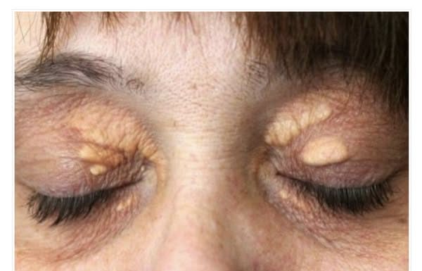 Ukoliko imate MASNO TKIVO ispod oka ovo MORATE uraditi