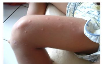 KOMARCI!? Nakon ovoga više nikada ih nećete ni vidjeti… DOVOLJNO JE SAMO PREPOLOVITI OVO VOĆE i…