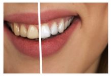 Zaboravite na zubara! Napravite pastu od tri sastojka koja uklanja kamenac i izbjeljuje zube