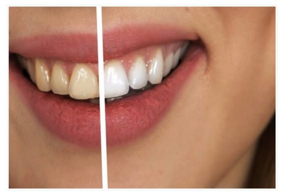 Zaboravite na zubara! Napravite pastu od tri sastojka koja uklanja kamenac i izbjeljuje zube