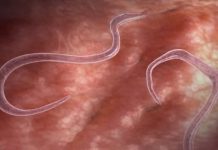 OVI ZNAKOVI UKAZUJU NA PARAZITE U STOLICI: Kako da prepoznate jesu li vam napali crijeva