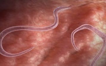 OVI ZNAKOVI UKAZUJU NA PARAZITE U STOLICI: Kako da prepoznate jesu li vam napali crijeva