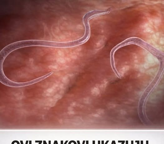 OVI ZNAKOVI UKAZUJU NA PARAZITE U STOLICI: Kako da prepoznate jesu li vam napali crijeva