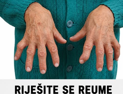 RIJEŠITE SE REUME ZAUVIJEK: Niti jedan lijek joj nije pomogao da izliječi REUMU, a onda je primjenila ovaj recept i ZAUVIJEK riješila svoj problem!