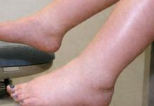 DA IZBACITE VIŠAK VODE POTREBAN VAM JE JEDAN VITAMIN: Ni noge vam više neće oticati, samo ga ubacite u ishranu