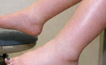 DA IZBACITE VIŠAK VODE POTREBAN VAM JE JEDAN VITAMIN: Ni noge vam više neće oticati, samo ga ubacite u ishranu