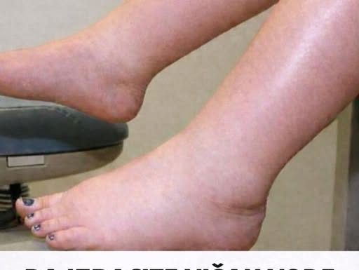 DA IZBACITE VIŠAK VODE POTREBAN VAM JE JEDAN VITAMIN: Ni noge vam više neće oticati, samo ga ubacite u ishranu