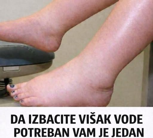 DA IZBACITE VIŠAK VODE POTREBAN VAM JE JEDAN VITAMIN: Ni noge vam više neće oticati, samo ga ubacite u ishranu