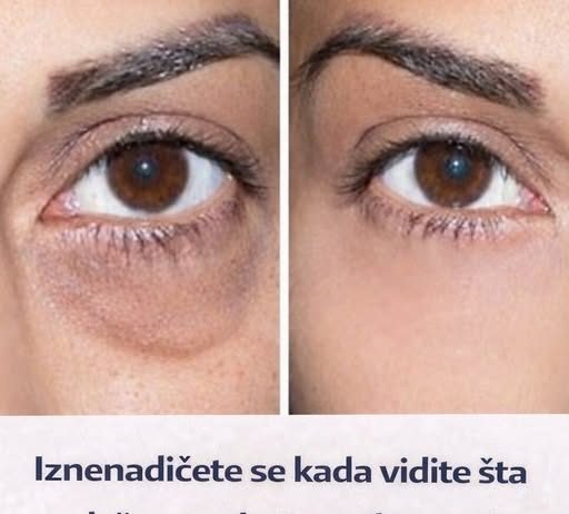 Iznenadićete se kada vidite šta se dešava sa kožom ako stavite sodu bikarbonu ispod očiju: Ovo je fenomenalno!