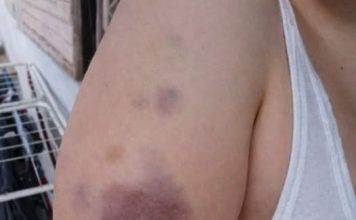 Zašto nastaju modrice i kada se treba zabrinuti