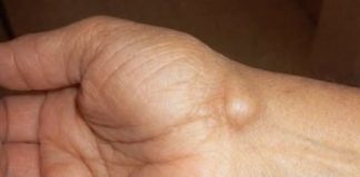 Imate li ovakve IZRASLINE: Evo kako da ih se riješite PREKO NOĆI