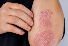 NIKAD VIŠE NEĆETE BACITI KORU OD OVE VOĆKE: Liječi psorijazu, skida bradavice i izbjeljuje zube