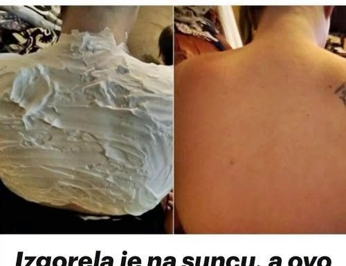 Izgorela je na suncu, a ovo ju je spasilo za 30 minuta: Svi to imamo u kući, a nije jogurt