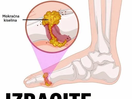 Izbacite mokraćnu kiselinu iz tijela, izliječite giht: 3 narodna lijeka koja provjereno djeluju