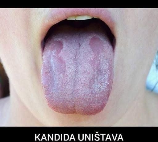 KANDIDA UNIŠTAVA ORGANIZAM I IMUNITET: Napravite ovaj napitak I ZAUVIJEK JE SE RIJEŠITE (RECEPT)