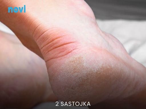 Domaći melem za grube i ispucale pete bake su znale napamet: Koriste se 2 prirodna sastojka