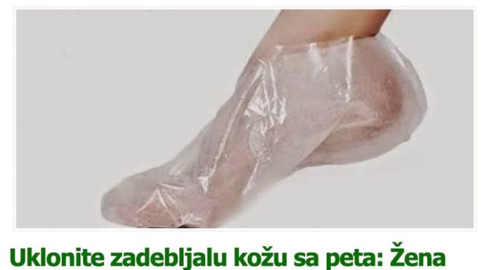 Uklonite zadebljalu kožu sa peta: Žena (57) otkriva sjajan recept od dva sastojka!